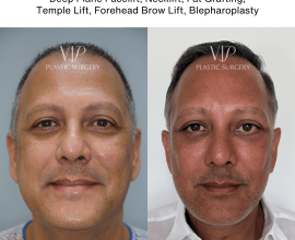 Male Facial Rejuvenation