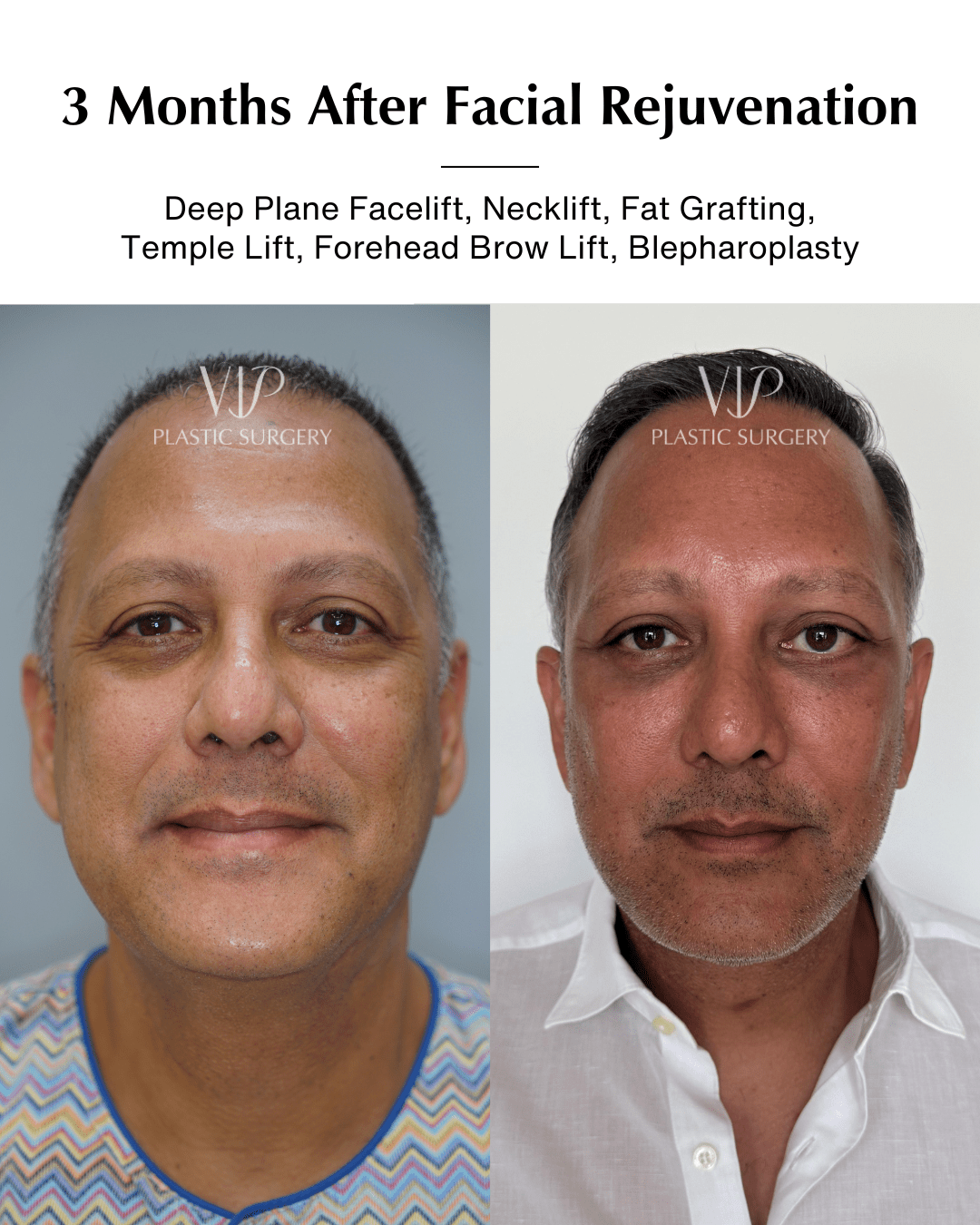 facial rejuvenation before after