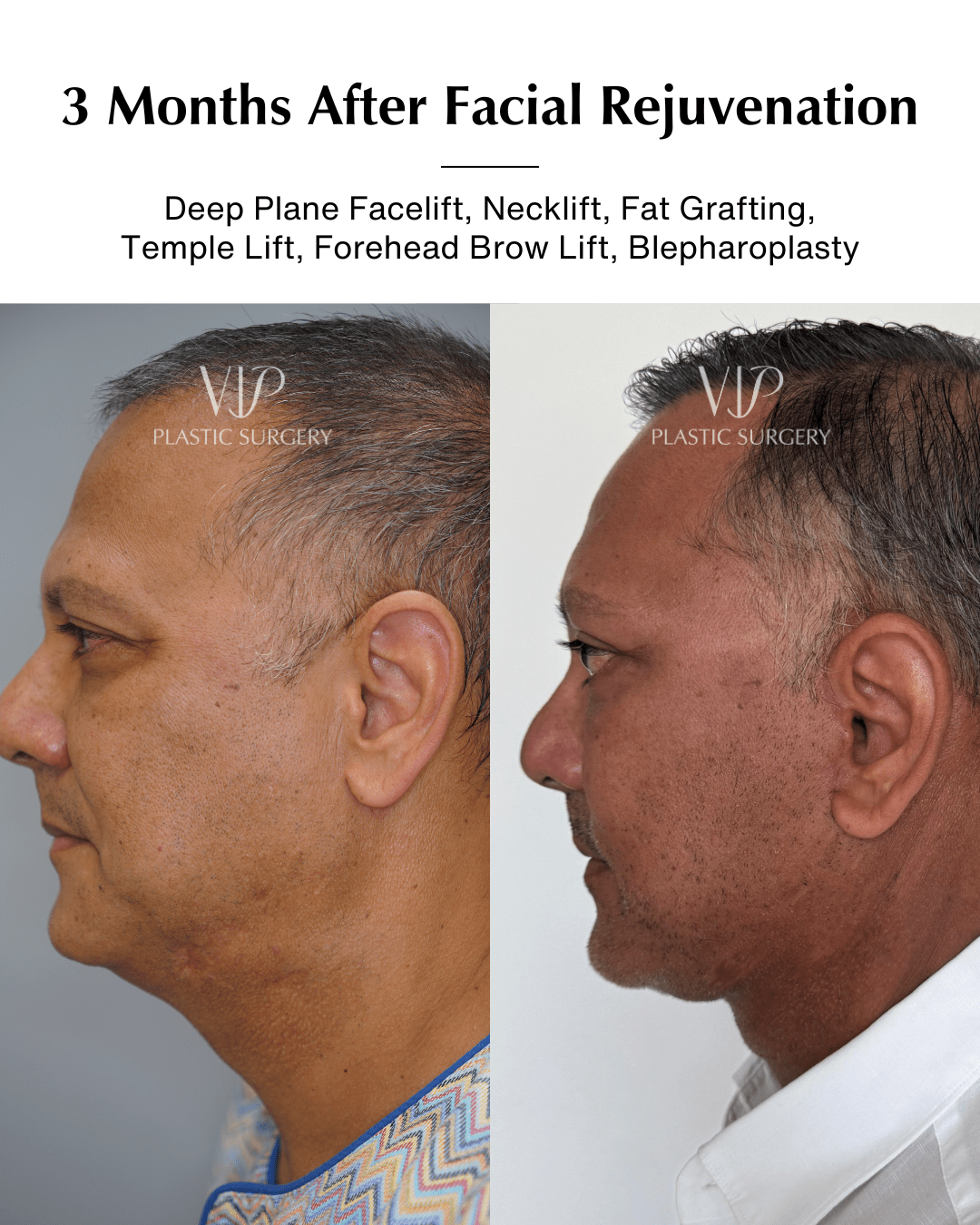 facial rejuvenation before after side