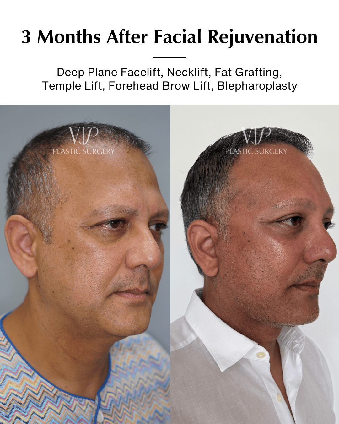 facial rejuvenation before after 45