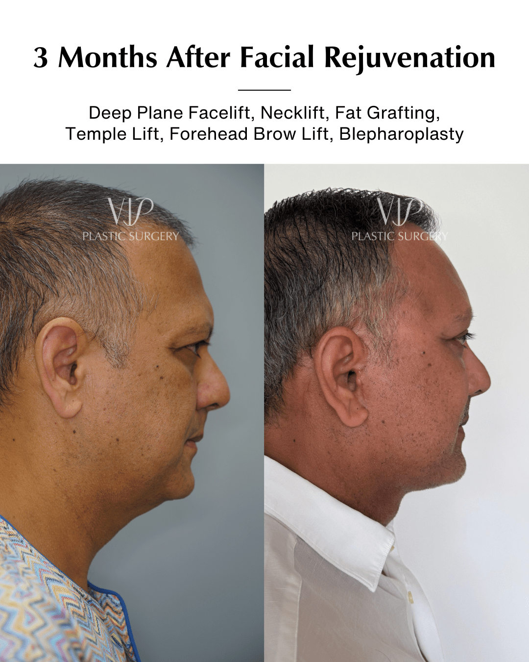 facial rejuvenation before after side