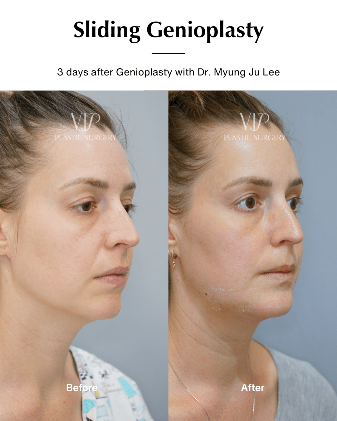genioplasty 45 degree