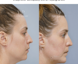 Sliding Genioplasty Chin Surgery