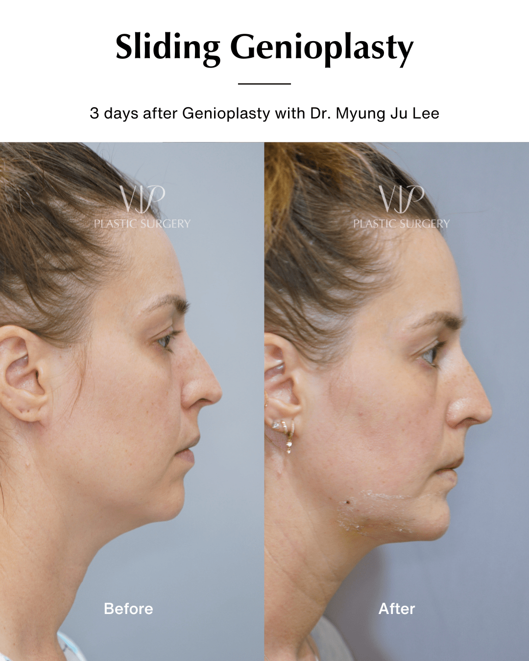 genioplasty side2