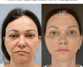 Revision Facelift & Necklift