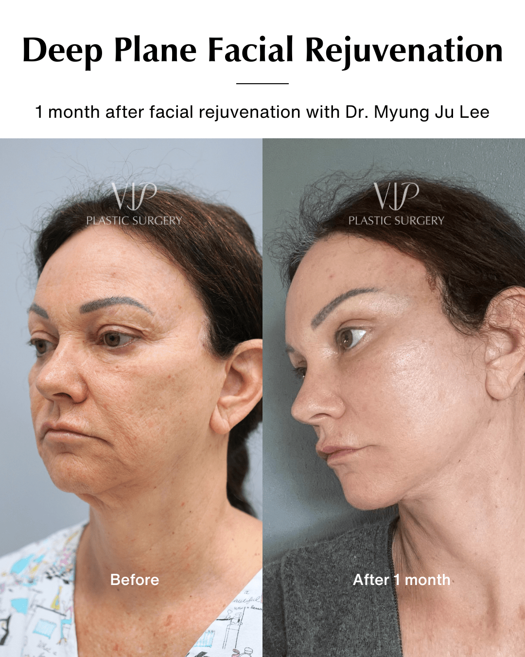 revision facelift before after