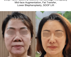 Rhinoplasty and Facial Rejuvenation
