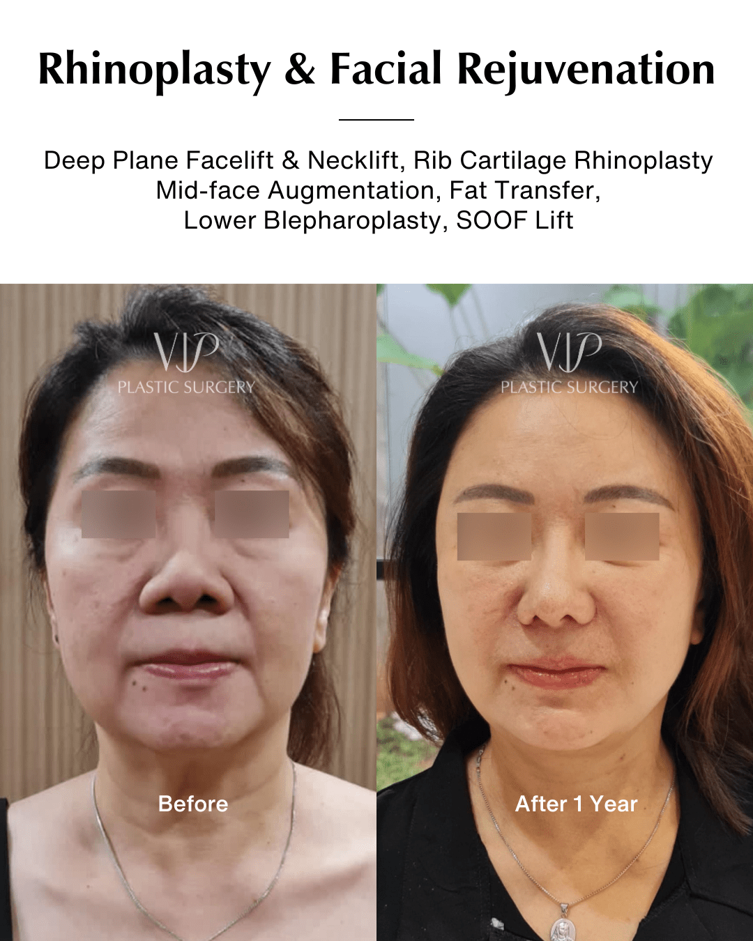 rhinoplasty and facial rejuvenation surgery