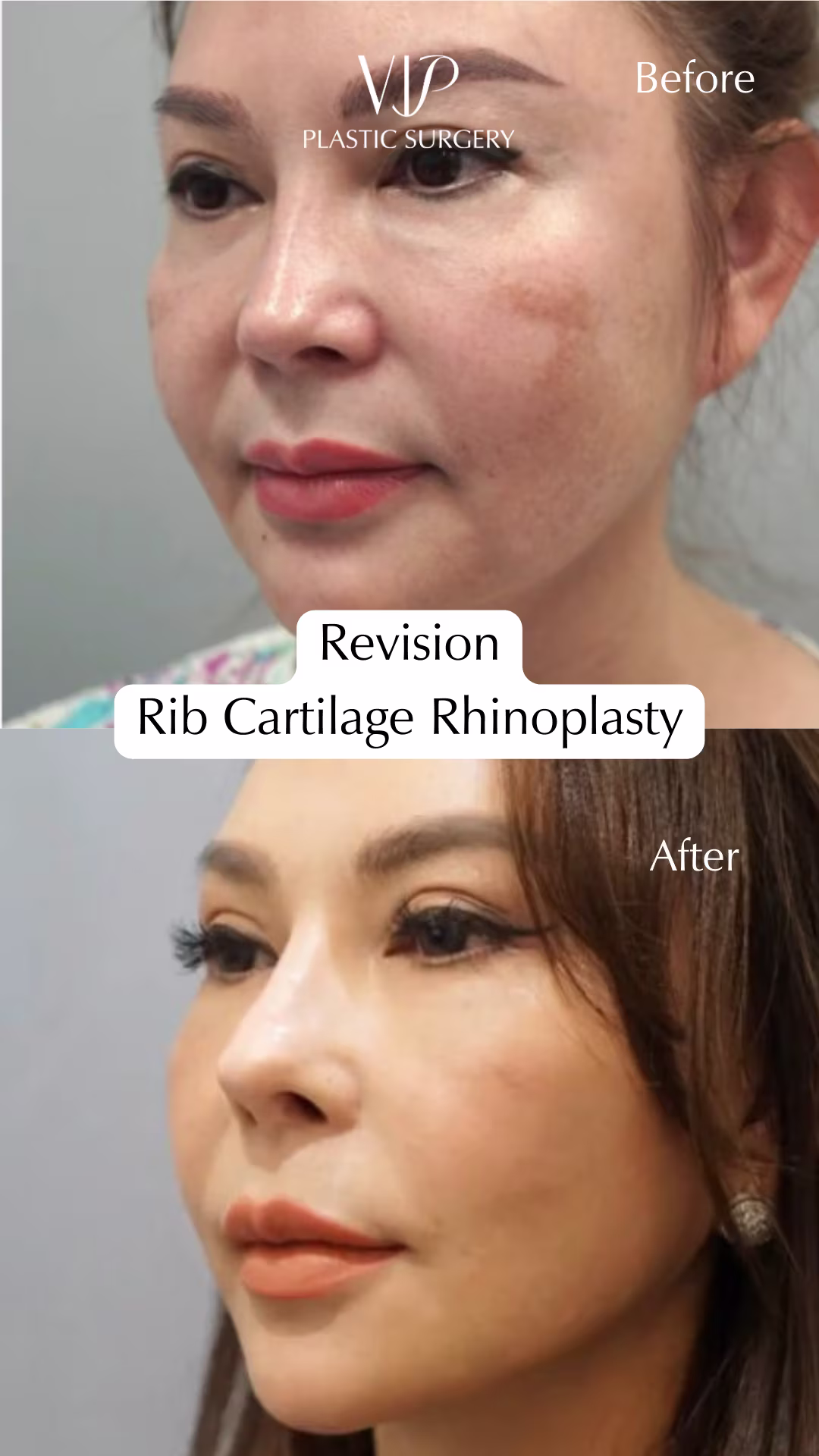 Rhinoplasty &amp; Extended Deep Plane Facelift Transformation Video