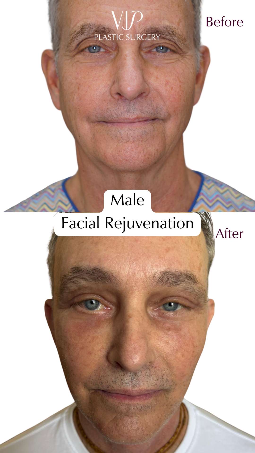 Caucasian Male Before After Extended Deep Plane Facelift and Deep Neck Surgery Video