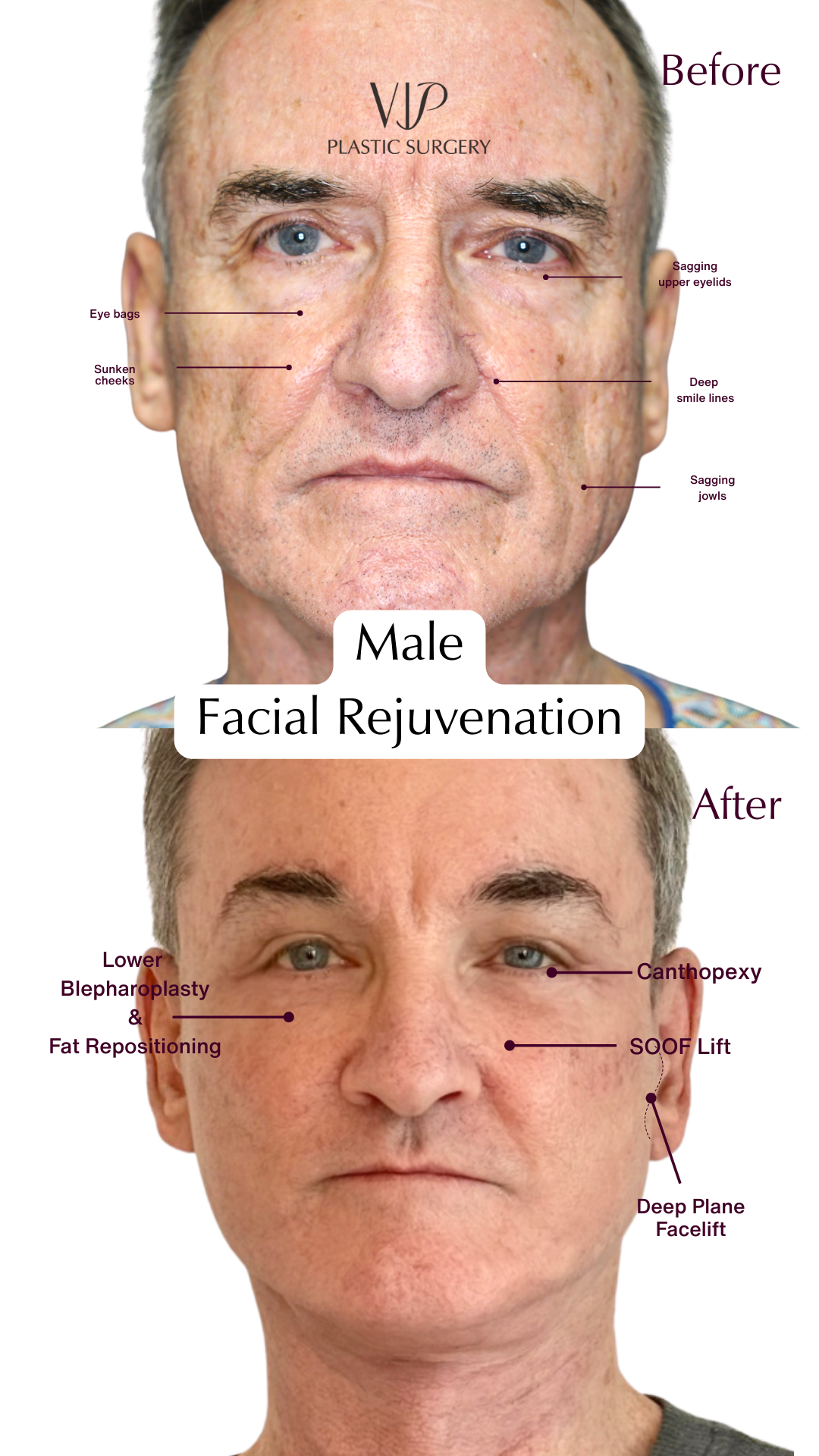 Eyelid Surgery, Facelift, Necklift Before & After Video