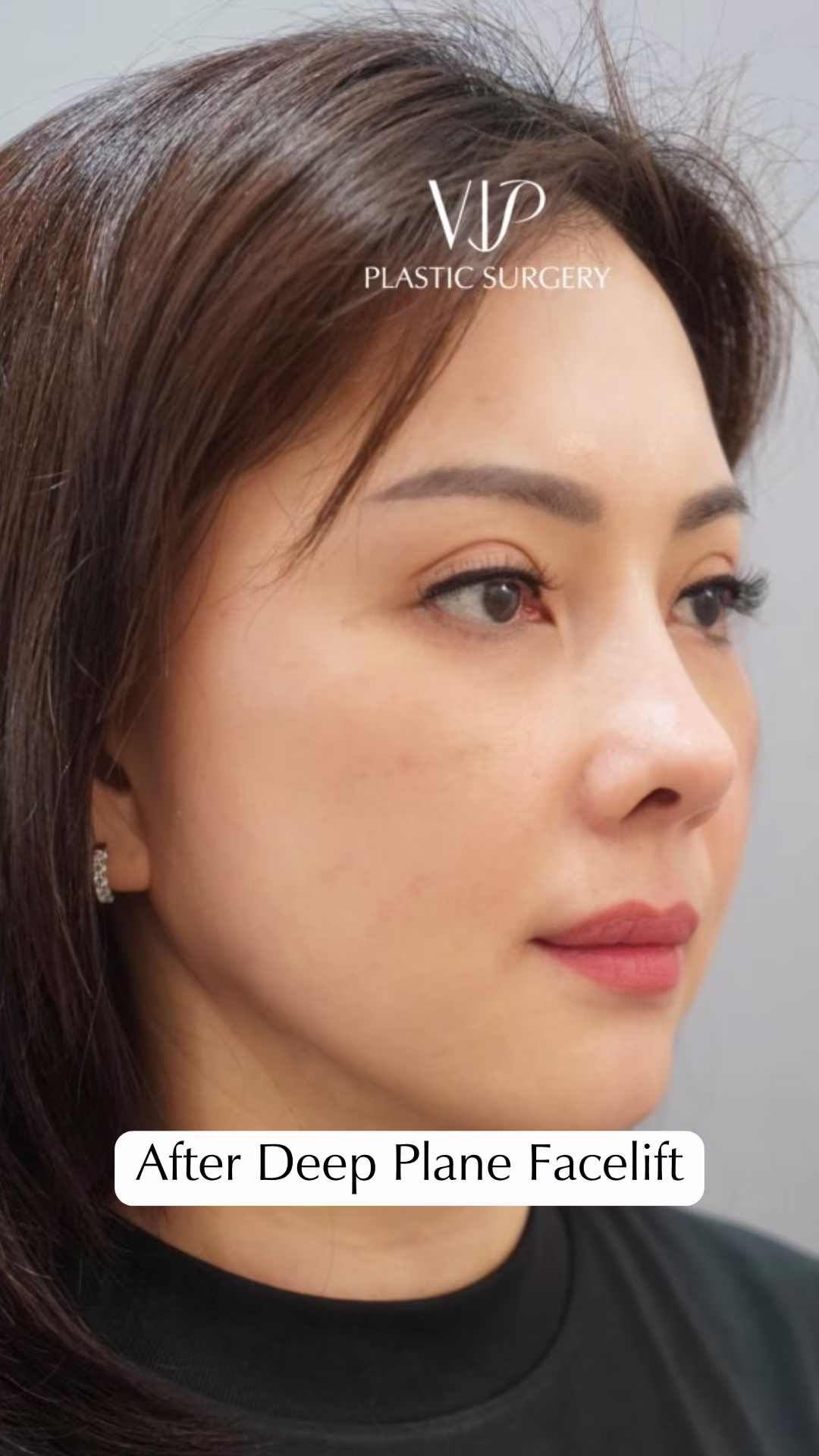Deep Plane Facelift for Asian Female Patient Video