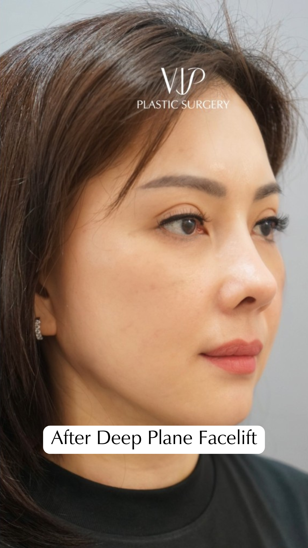 Deep Plane Facelift for Asian Female Patient Video