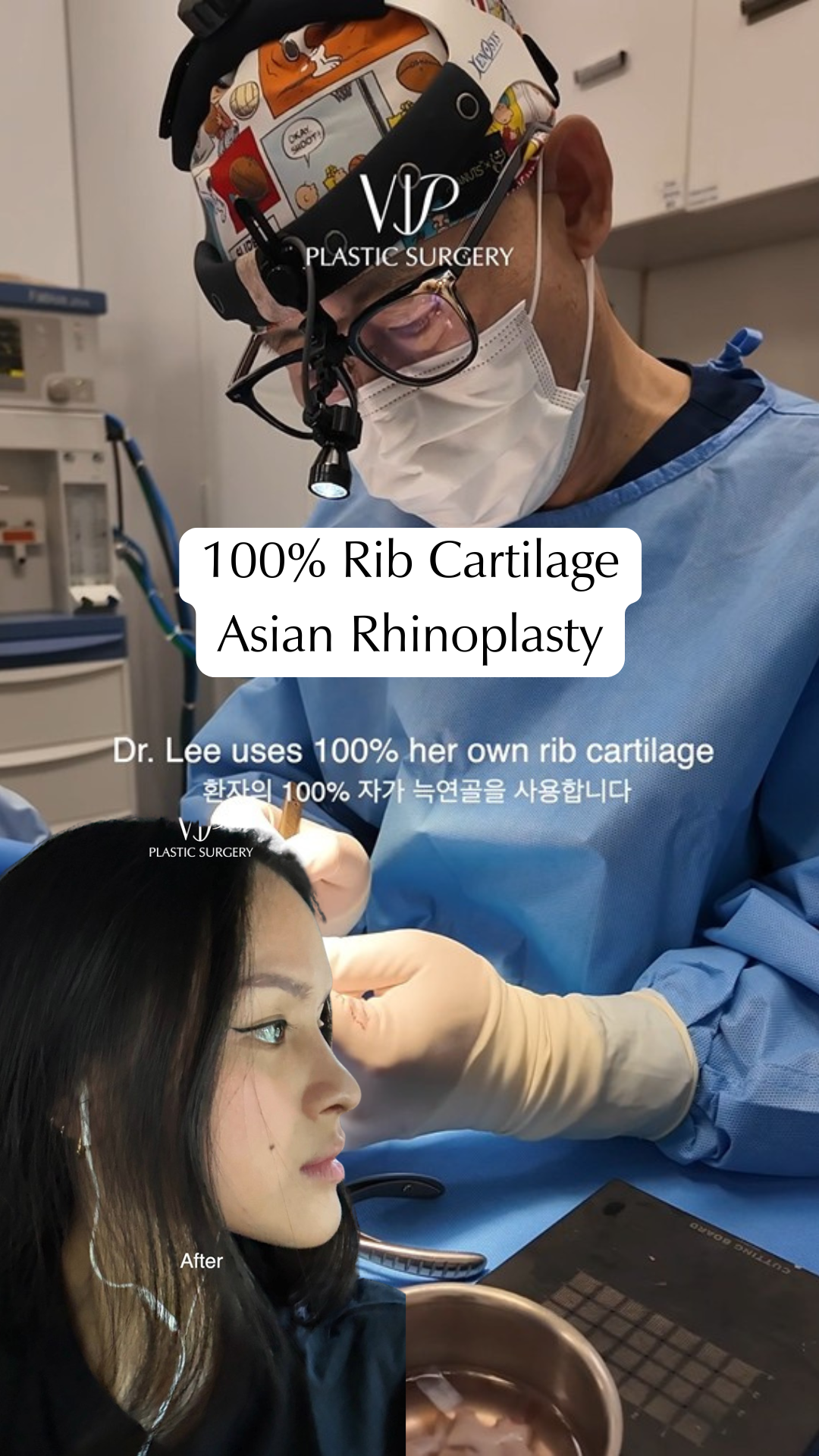 Before and After of 100% Rib Cartilage Rhinplasty