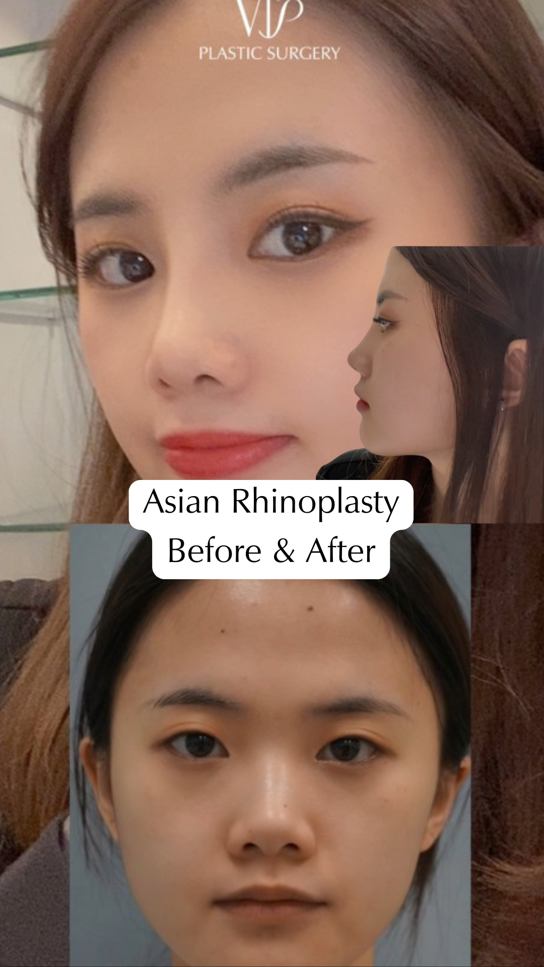 Asian Rhinoplasty Before and After