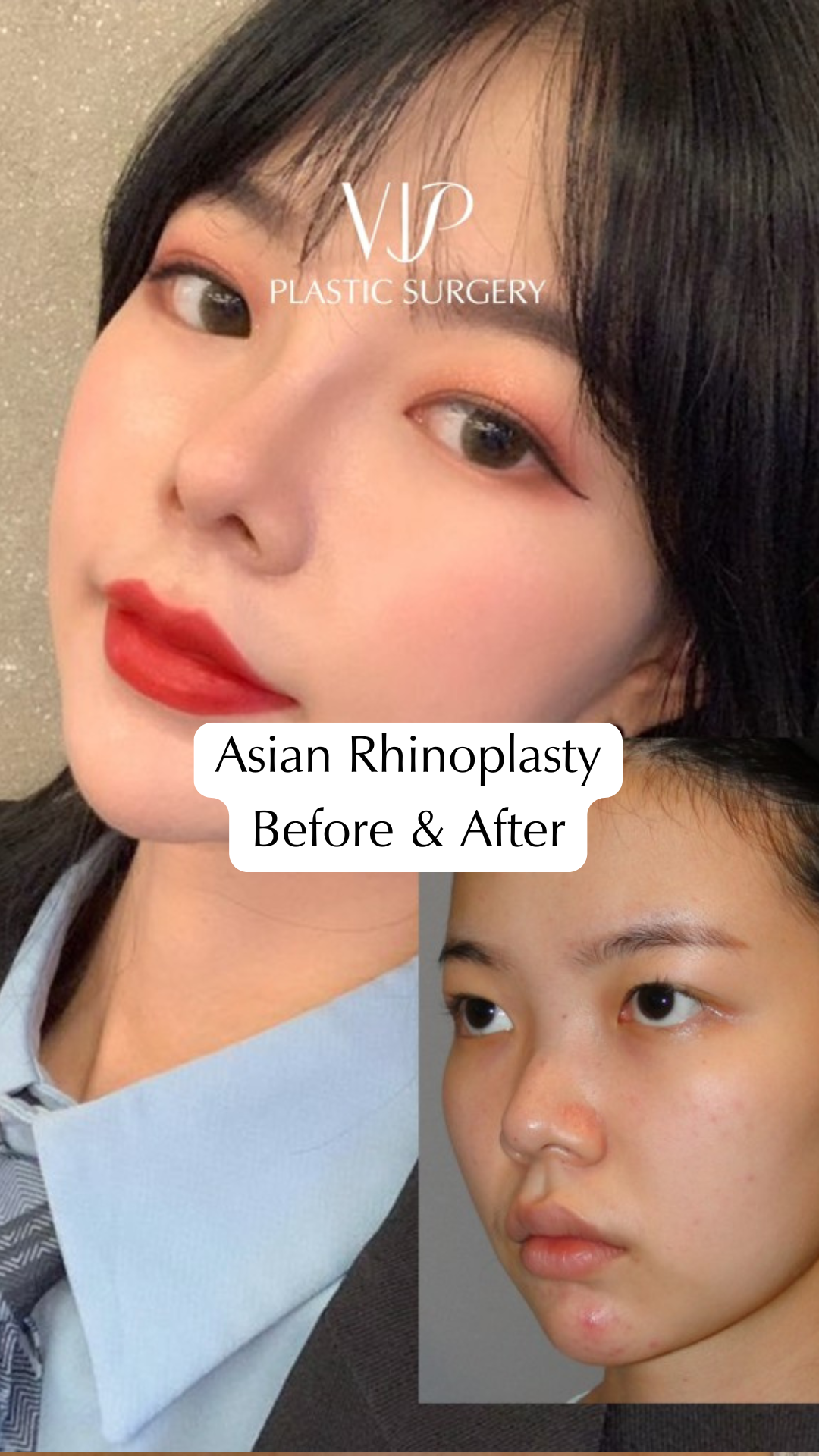 Asian Nose Surgery Transformation