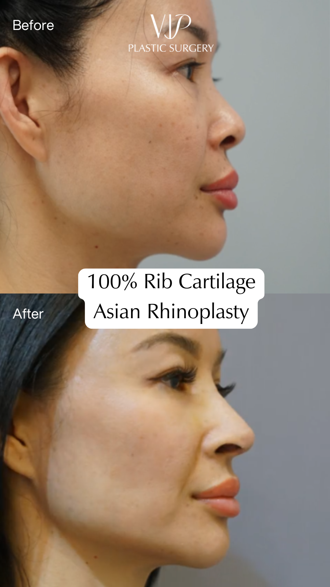 Asian Rhinoplasty Before After with 100% Rib Cartilage
