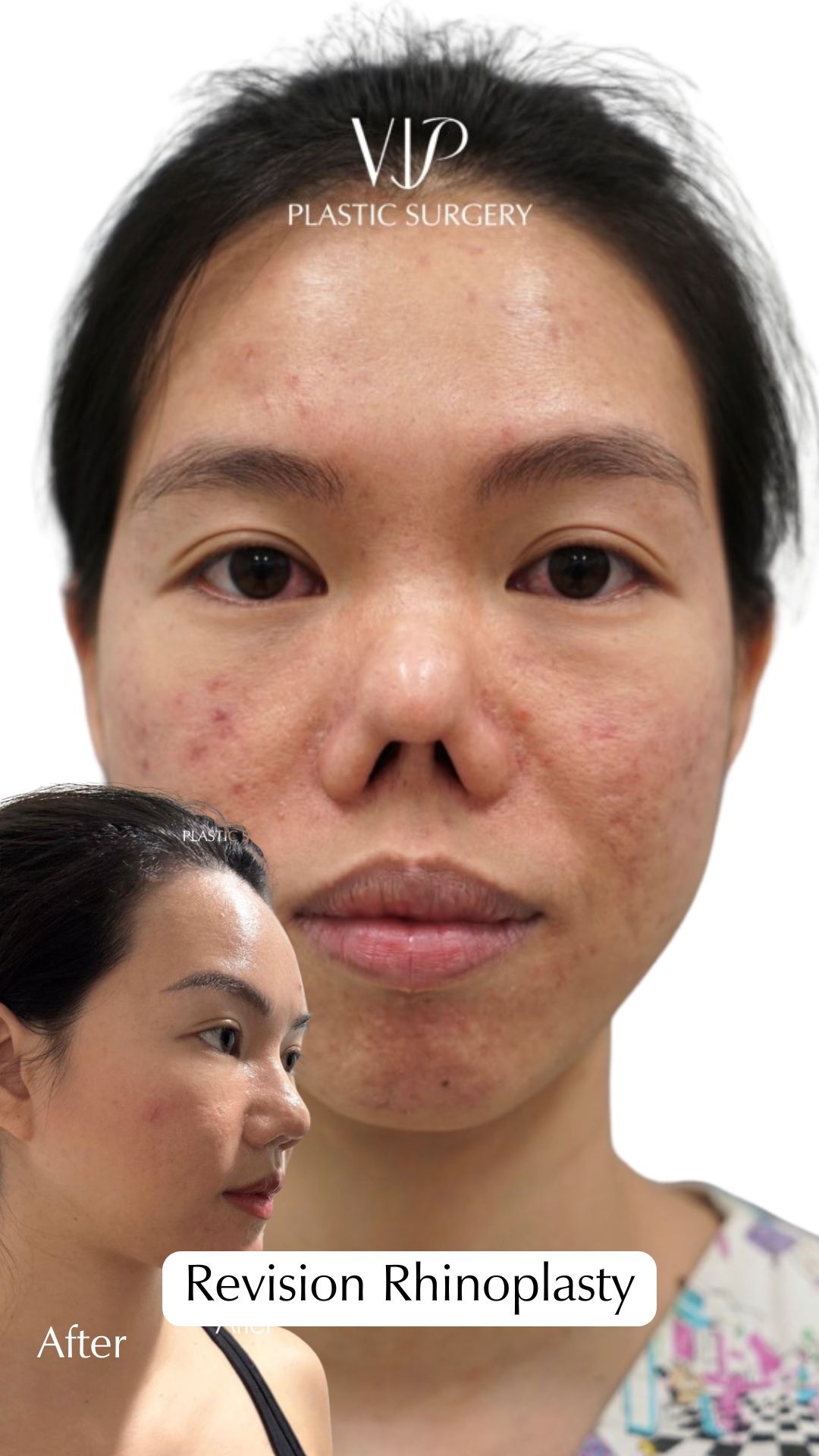 Revision Rhinoplasty - Reconstructive Surgery with Rib Cartilage