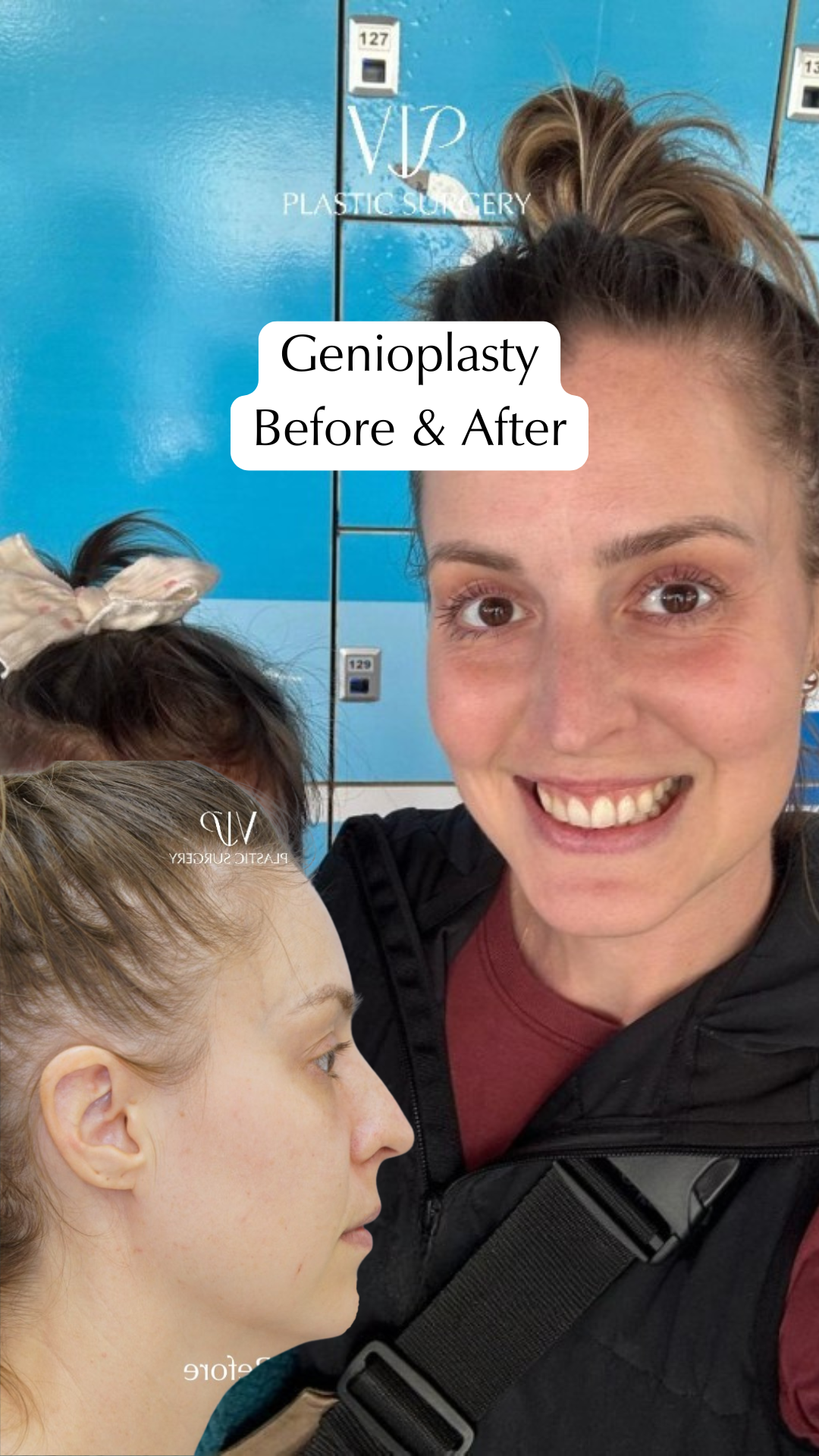 Advanced Genioplasty Before and After