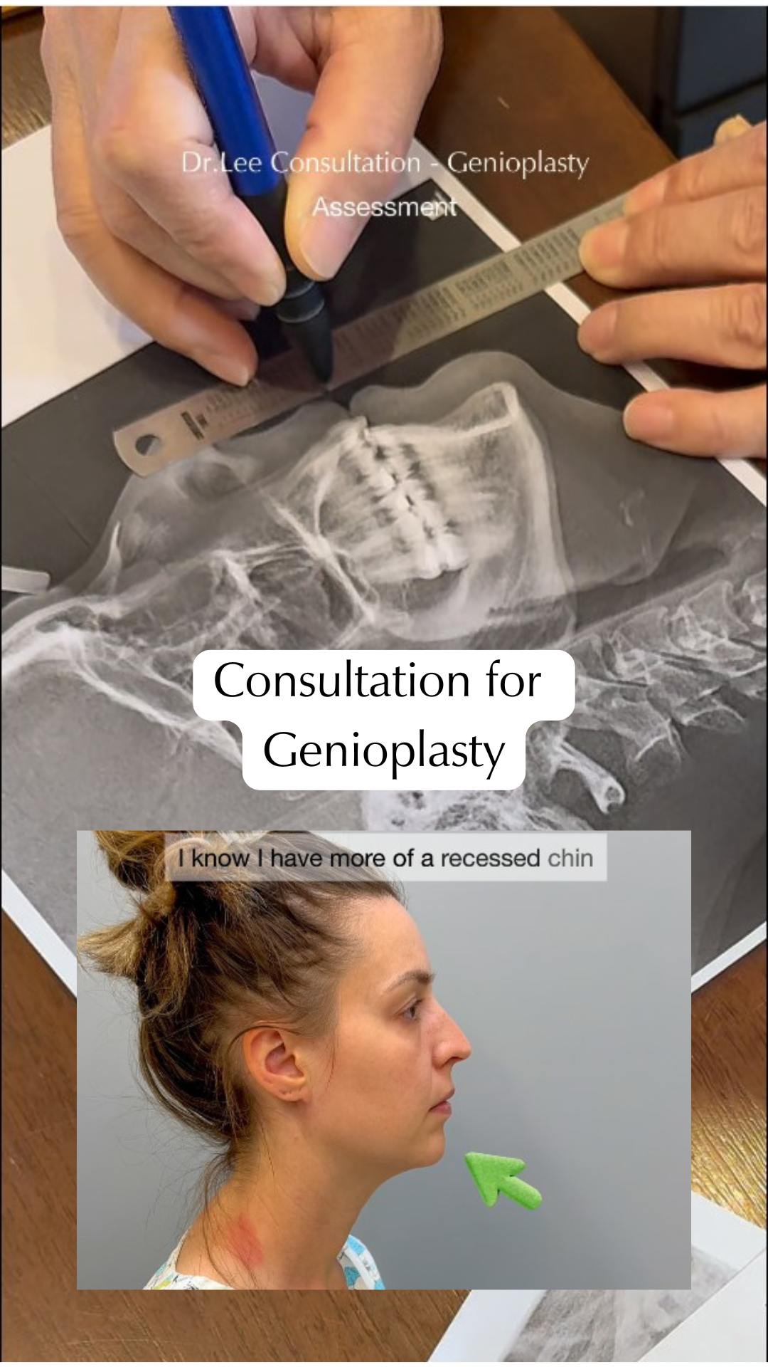 Sliding Genioplasty Pre-operation Consultation