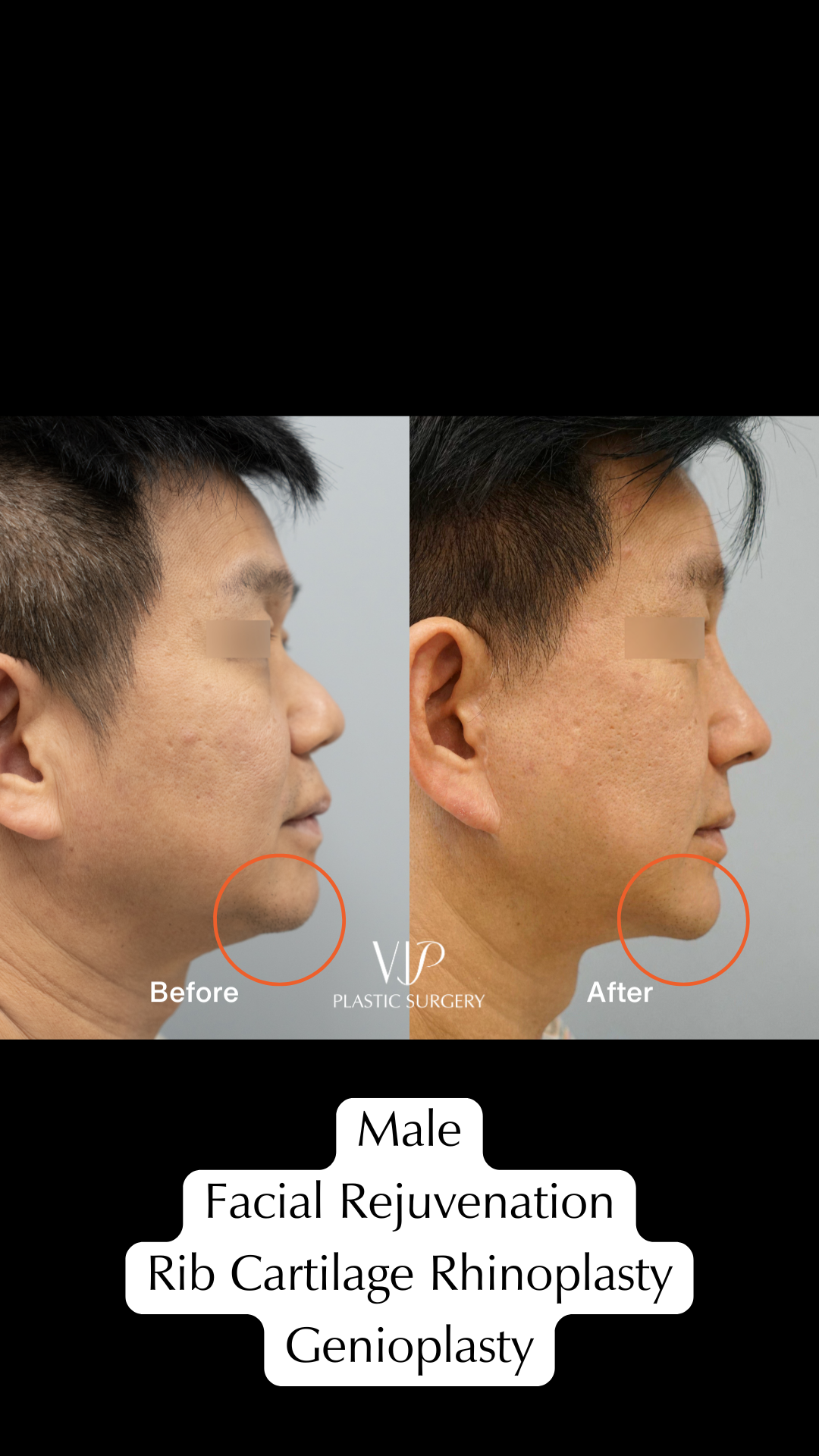 Asian Male Rhinoplasty and Extended Deep Plane Facelift