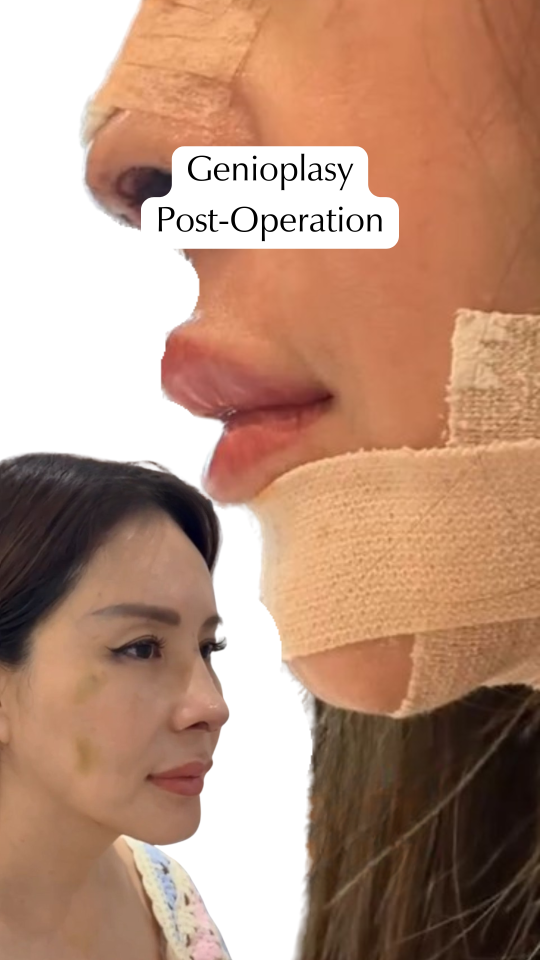 Revision Rhinoplasty and Advanced Genioplasty Before and After