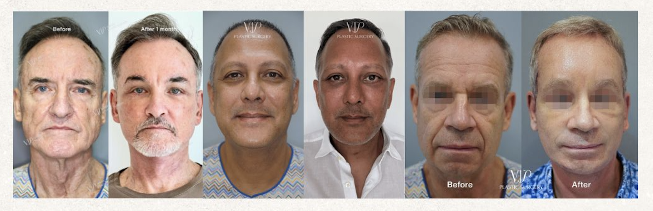 deep plane male facelift