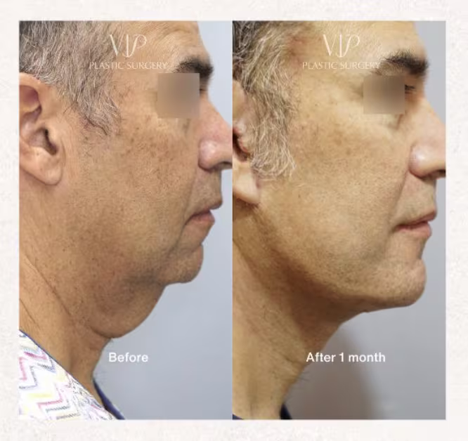 sub mandibular gland reduction