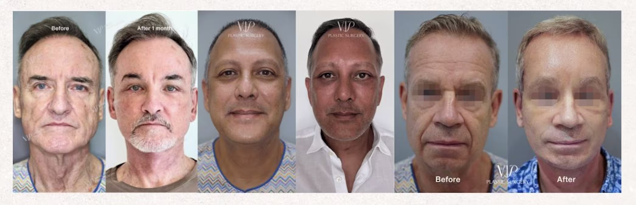 Deep Plane Male Facelift