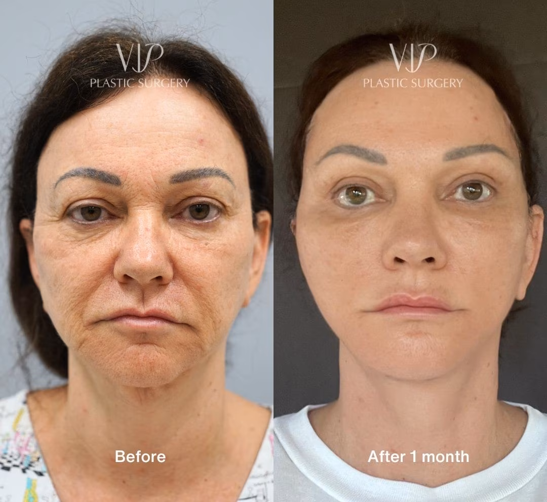 facelift and fat grafting by VIP clinic