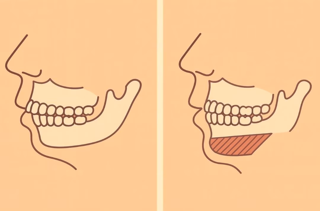 Why Surgeons Recommend Genioplasty Over Chin Implants