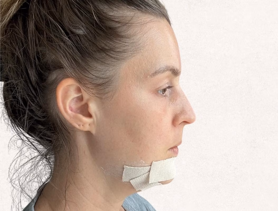 VIP clinic genioplasty patient 