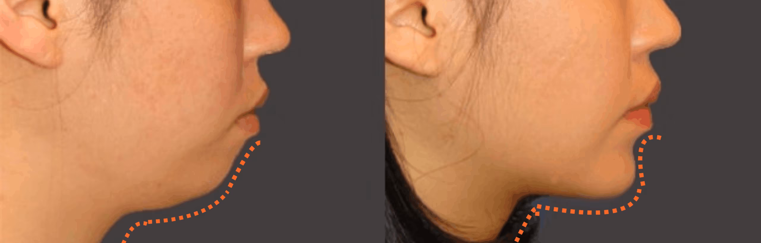 VIP clinic genioplasty patient