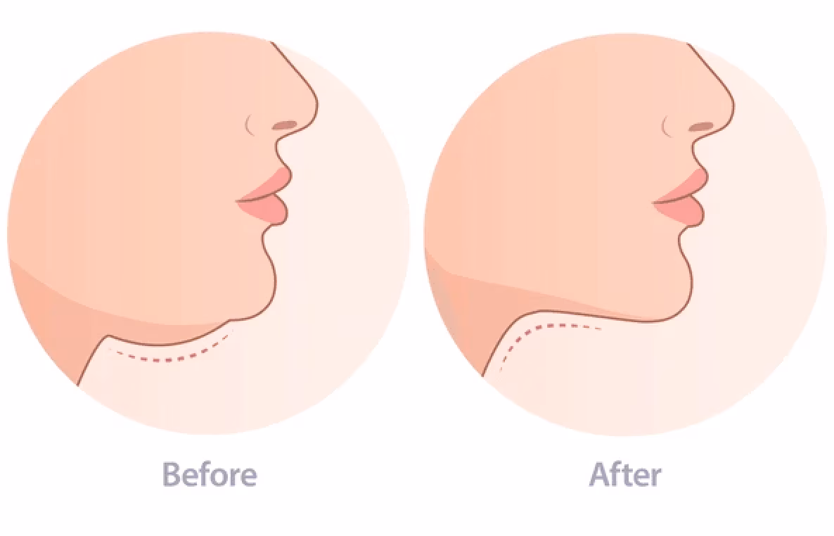 double chin before after