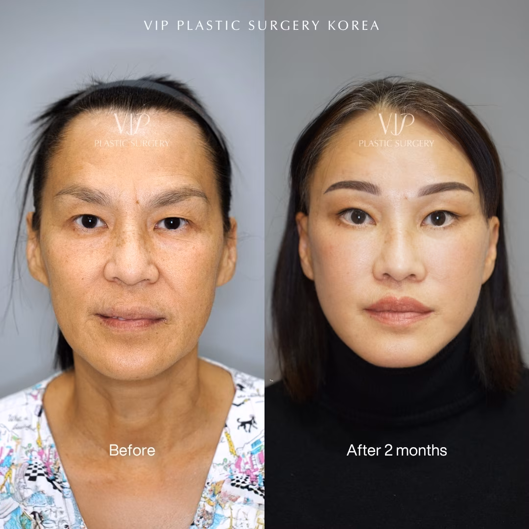 Deep Plane Facelift Before After front view 50s asian after 2 months