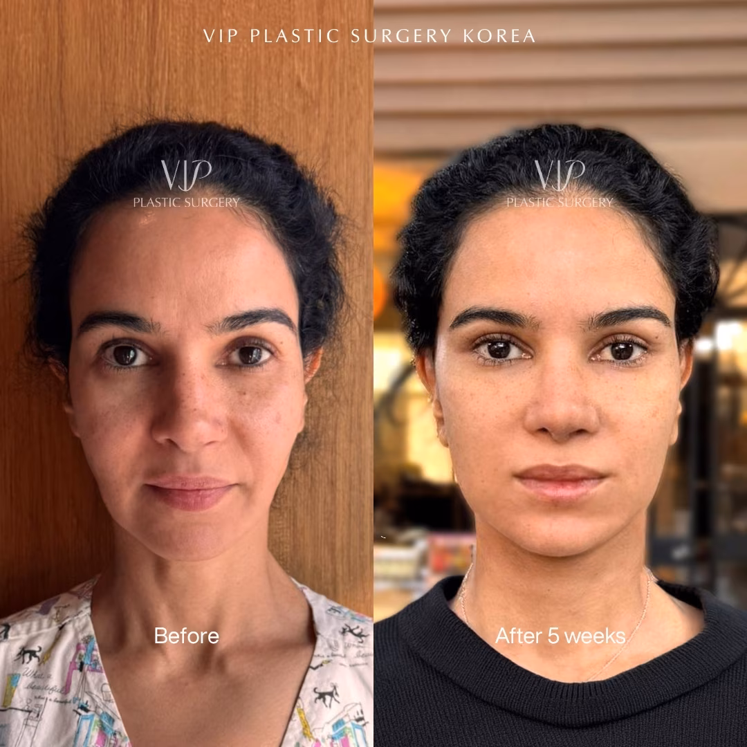 Facial Rejuvenation Before After front view 40s caucasian after 5 weeks