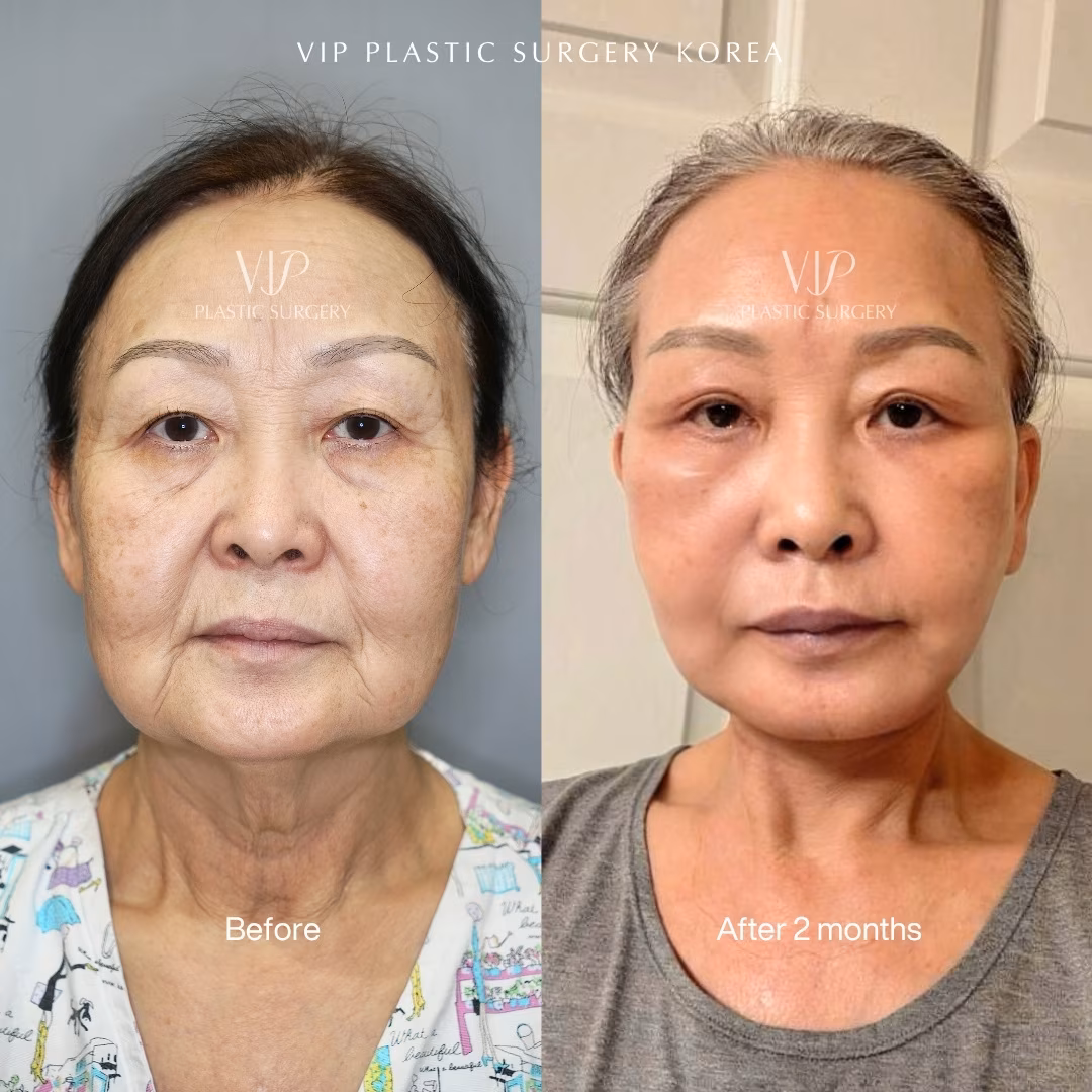 Deep Plane Facelift, 60s Asian after 2 months (front view)