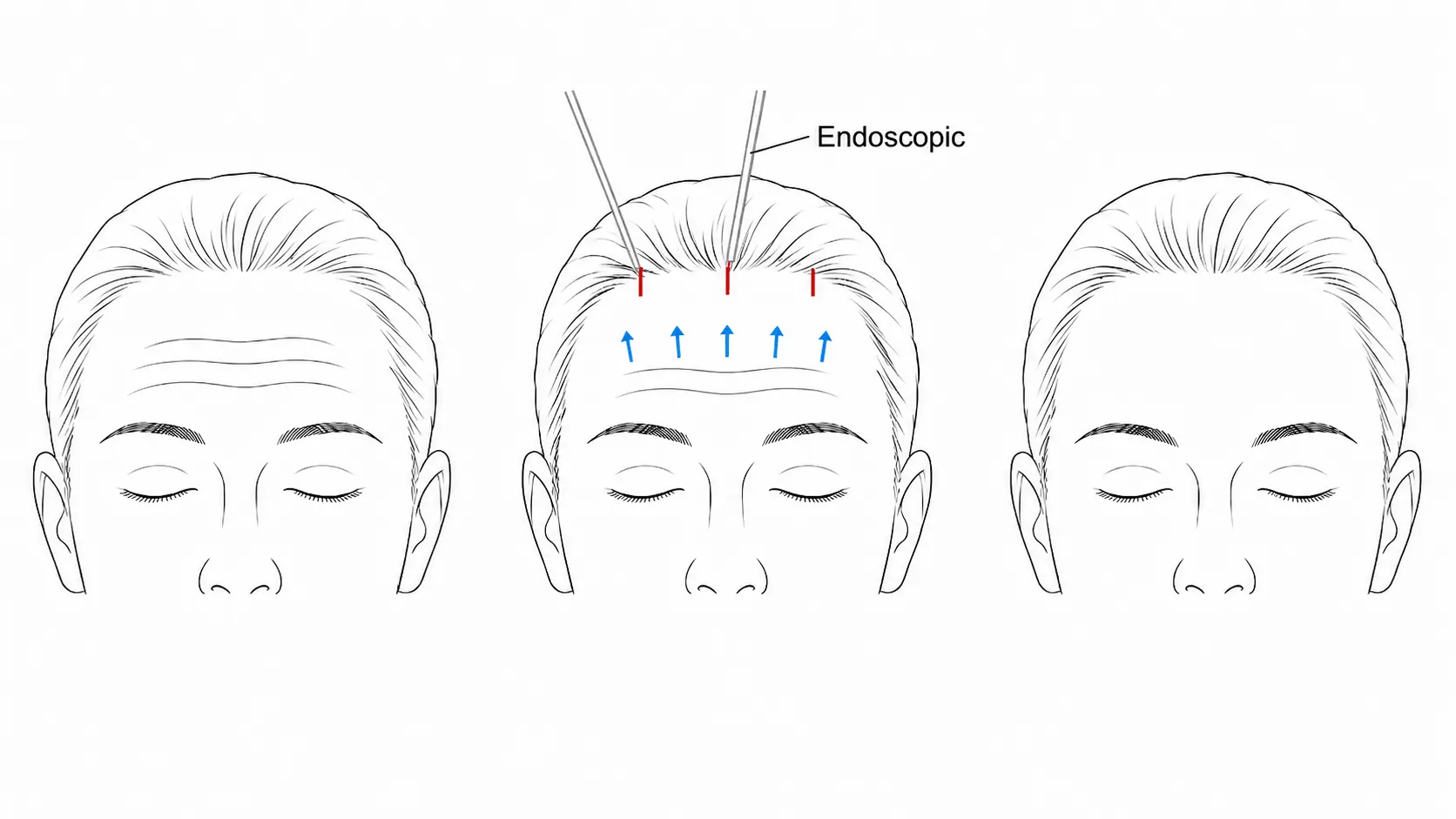 endoscopic forehead lift surgery illustration